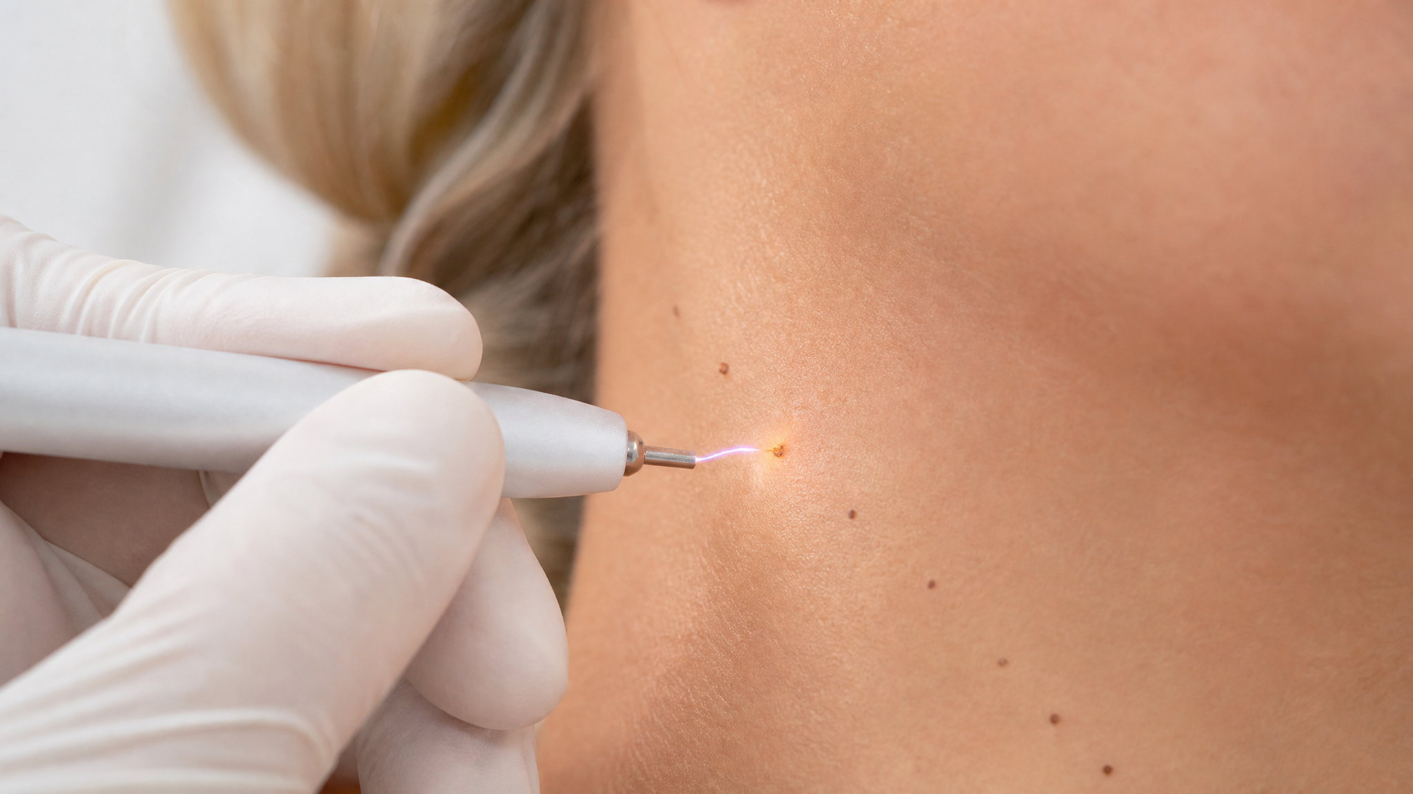 Plasmapen-behandlingen i närbild, plasma-gnista mot skin tag på hals